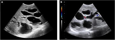 Childhood-onset Caroli’s disease as a cause of recurrent fever: A case report